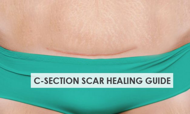 C-Section Scar Healing Care Guide